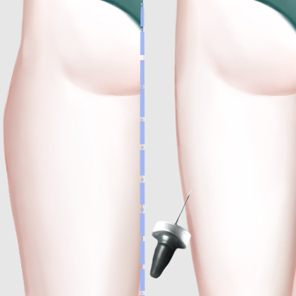 射频溶脂瘦大腿