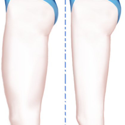 冷冻溶脂瘦大腿
