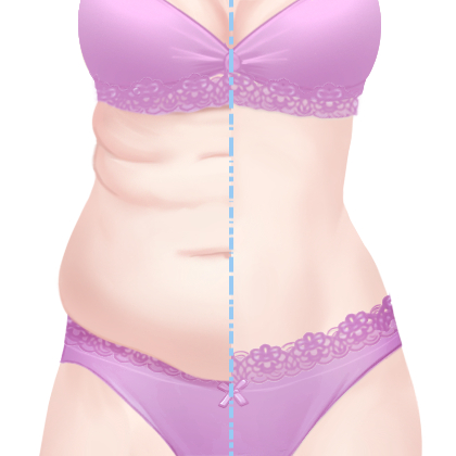 冷冻溶脂瘦腰部