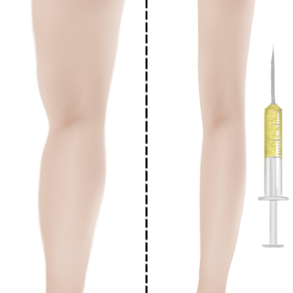 冷冻溶脂瘦小腿