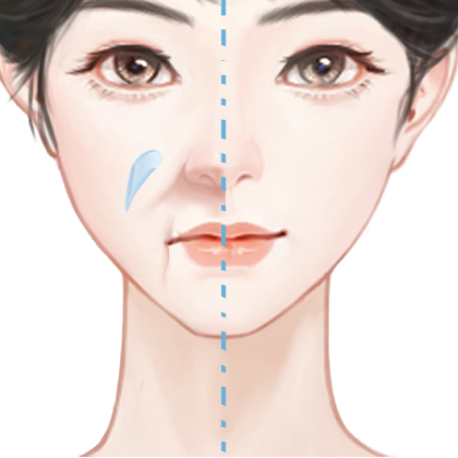 胶原蛋白隆鼻
