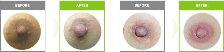 自体脂肪丰胸手术效果如何